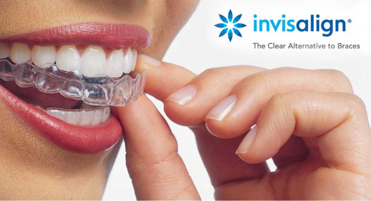 Invisalign Appointment