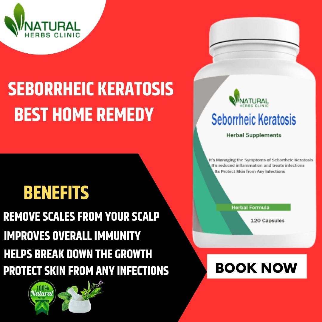 Seborrheic Keratosis Utilize Various Natural Treatments That Helpful