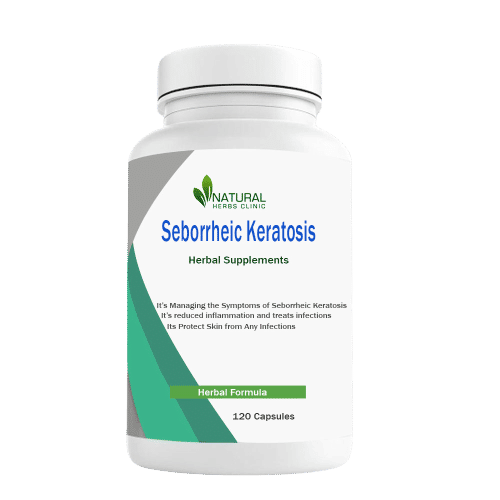 Seborrheic Keratosis Utilize Various Natural Treatments that Helpful