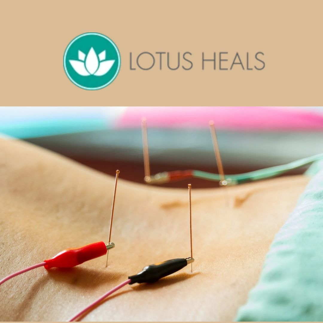 The Science Behind Acupuncture How It Works for Pain Management