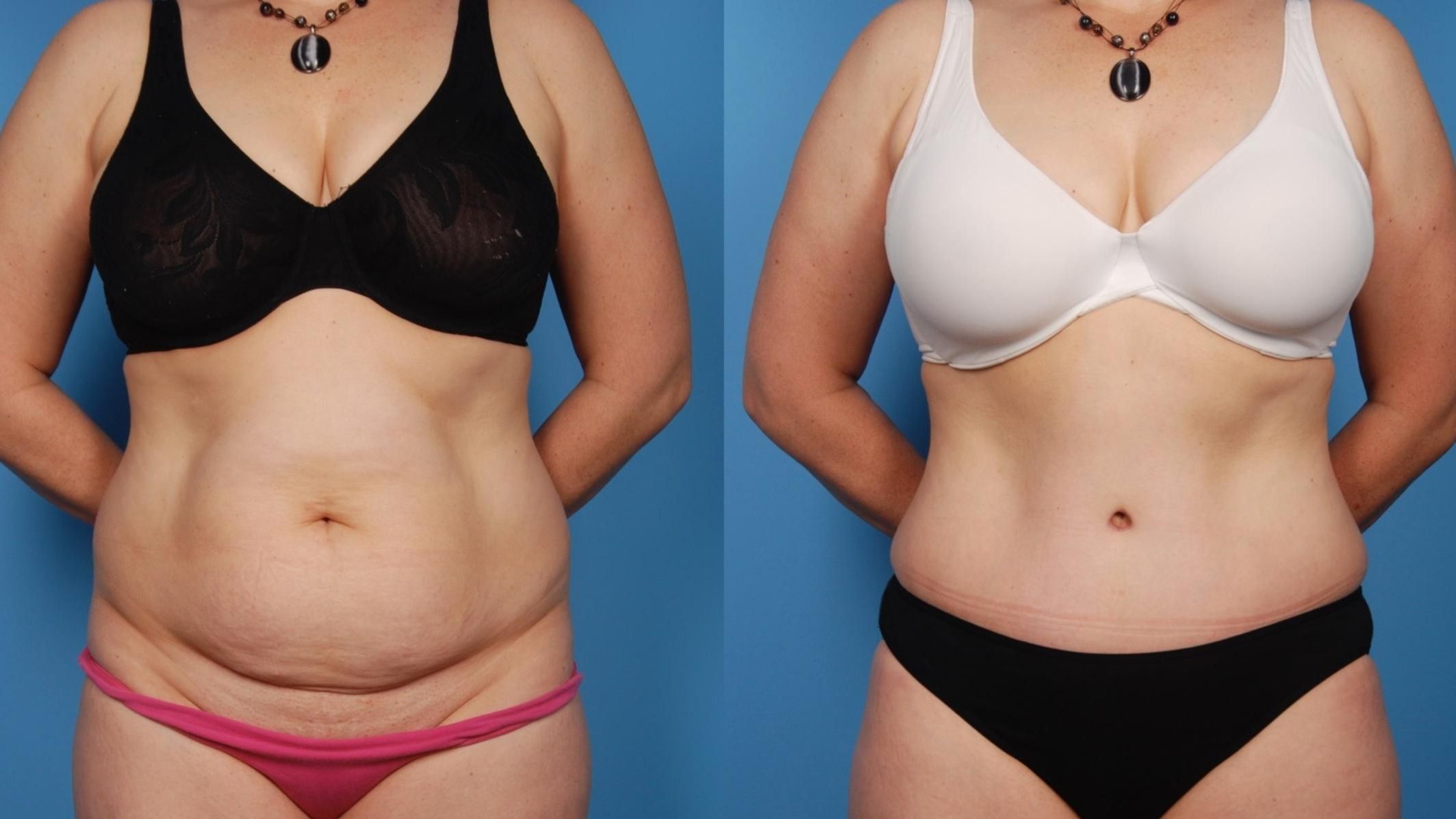 Top 10 Tummy Tuck Surgeons In India Can Totally Change Your Life