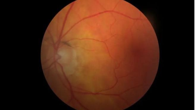 optic-nerve-hypoplasia-how-is-it-diagnosed-viezec-medical-health