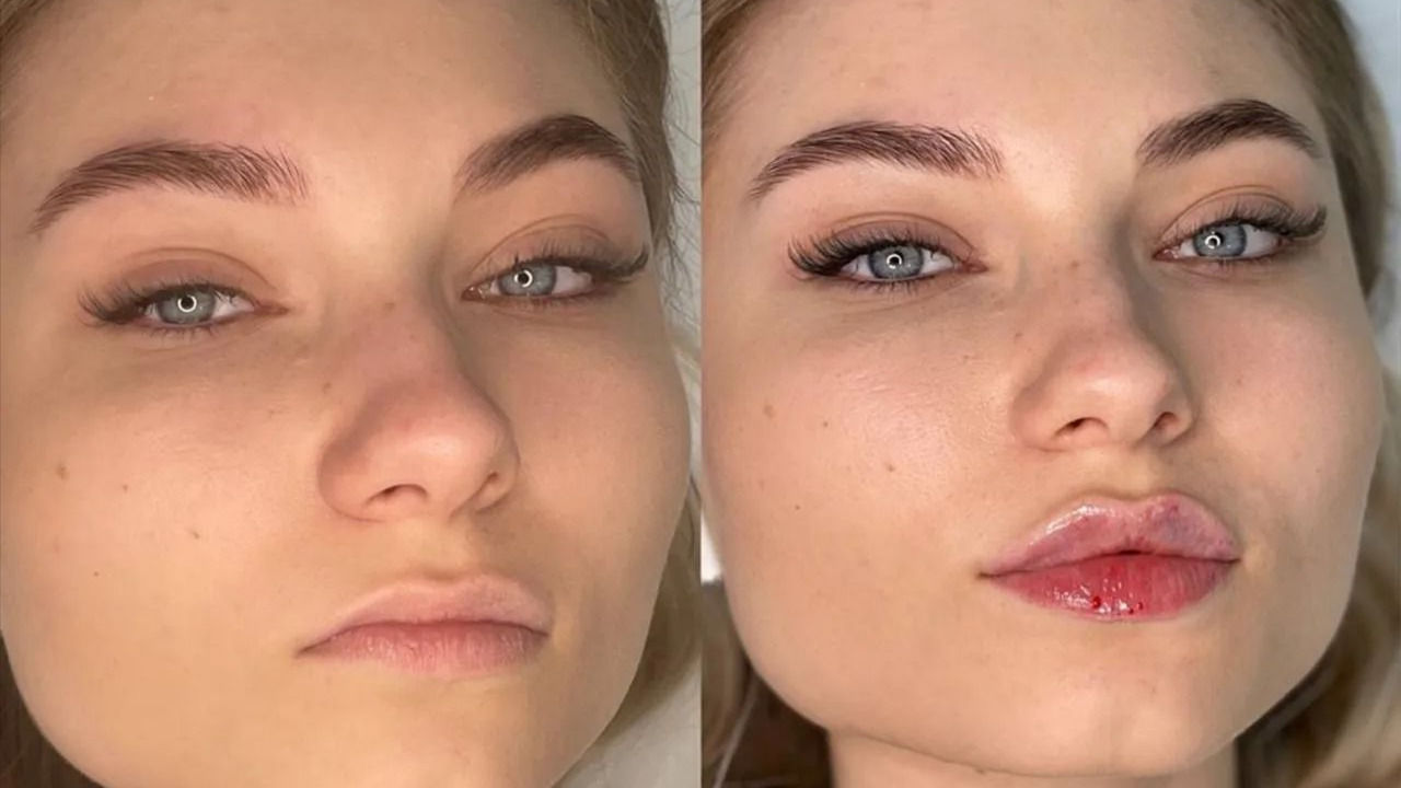 Lip Augmentation Service DOs and DON’Ts 101! Doctor_AMB (Anna Mariya