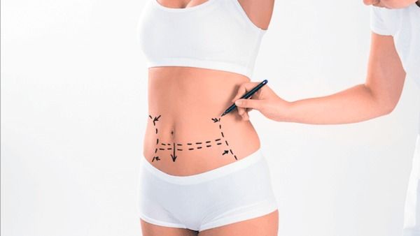 A Guide To Understanding And Knowing More About Liposuction Fibrosis Treatment Orlando Florida 6053